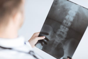 Doctor holding x-ray of patient's spine